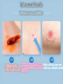 50pcs/100pcs/200pcs Disposable Acne And Pimple Extractor, Dermatological Acne Removal Tool For Facial Care And Salon