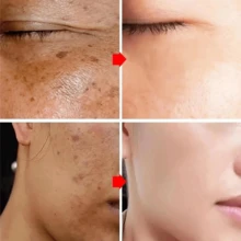 2Pcs Dark Spot Remover For Face And Body, Dark Spot Corrector Cream, Age Spot Sun Spot Freckles Brown Spot Remover, Melasma Treatment For Face, Mild And Non-Irritating, Non-Greasy And Easy To Absorb - Dark Spot Cream - View 3