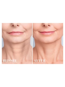 11 Pieces Anti-Wrinkle Silicone Patch For Face, Forehead, Bust And Neck - Clear - View 5