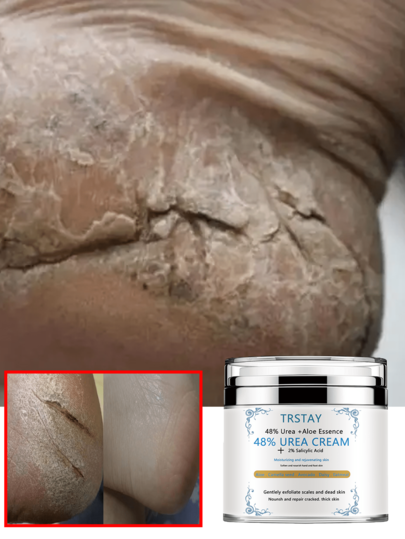 Powerful Moisturizing Heel Cream For Dry Cracked Feet With Natural Ingredients Deeply Soothes And Softens Heels Provides Pain Relief And Hydration For Rough Skin Long Lasting Moisture Repair Cracked Heels Restore Smoothness Nourish Dry Skin Prevent Future Cracks