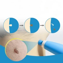 2-In-1 Automatic Skin Tag Removal Kit, Painless Care For Most Body Parts (2-8mm), Home Care Tool Accessories - 藍色 - 查看 2
