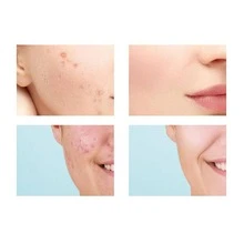Hydrocolloid Patch For Acne And Pimples – 36 Units - trắng - Xem 5
