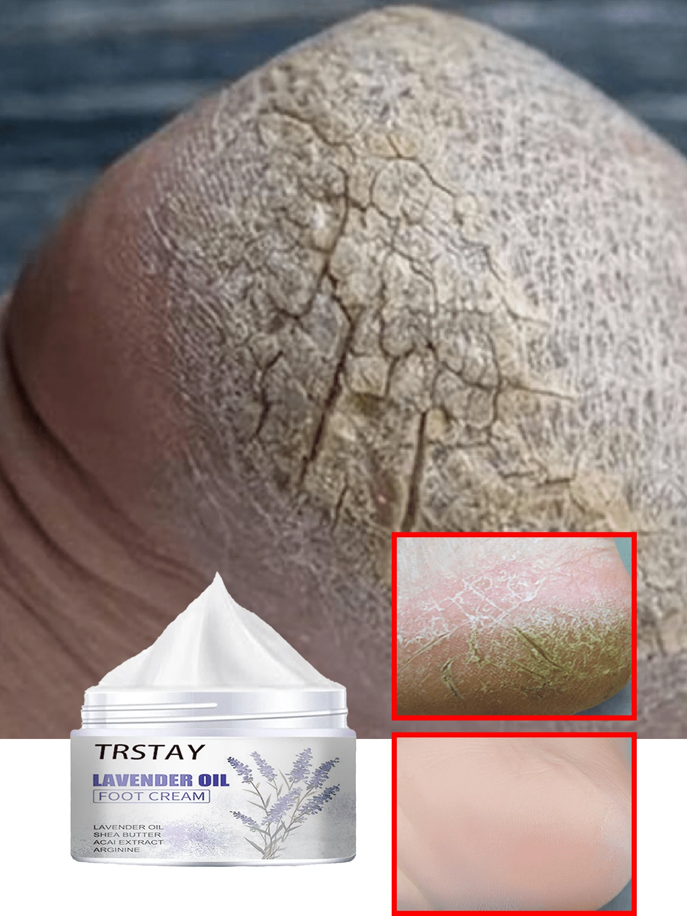 Foot Cream With Shea Butter And Vitamin E For Dry Cracked Heels And Rough Skin Deep Hydration Moisturizing Nourishing Care For Soft Smooth Feet All Day Long