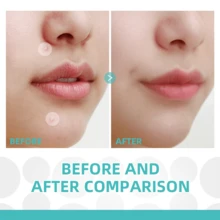 720片透明祛痘贴，透气隐形超薄亲肤遮瑕防水 - 無色 - 查看 4