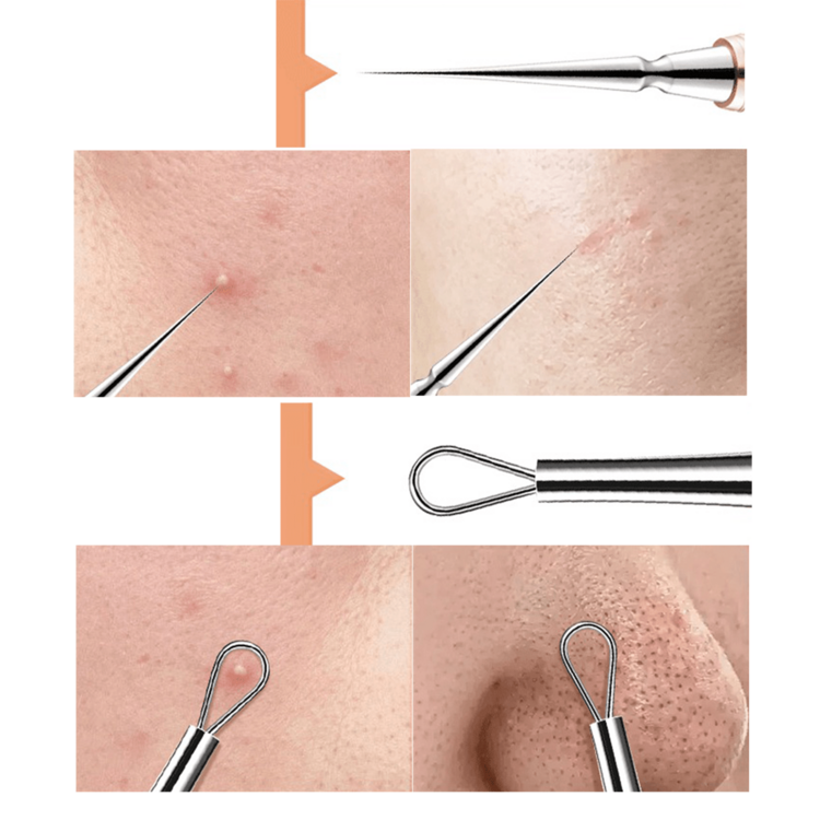 1pc Stainless Steel Blackhead Remover, Pimple Acne Extractor, Face Care Pore Cleansing Tool - Multicolor - View 5