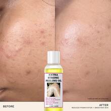 Yellow Peeling Oil For Dark Skin Strong Peel Oil Extra Strength Exfoliating Chemical Exfoliant Peels Solution At Home Body Peeling For Exfoliate Body Hand Foot Knuckle All Skin Type - Default - View 6