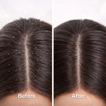 90ml Champú de Ketoconazol, Alivio para la Dermatitis Seborreica, Control Anti-Caspa y Picazón, Tratamiento para el Cuidado del Cuero Cabelludo, Para Hombres y Mujeres - Champú - Ver 6