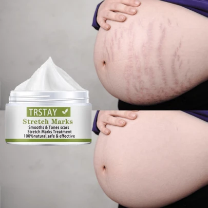 TRSTAY:"Crema de reparación y renovación StretchFade con colágeno, mantequilla de karité y extractos naturales para una piel más suave, firme y una apariencia reducida de estrías"