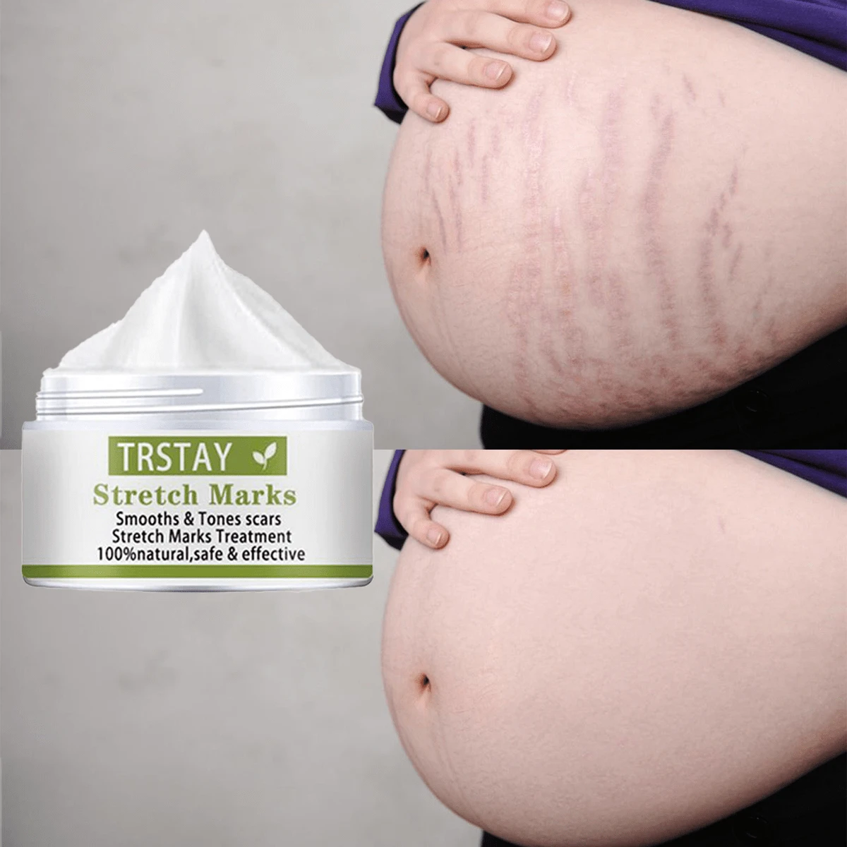 TRSTAY:"Crema de reparación y renovación StretchFade con colágeno, mantequilla de karité y extractos naturales para una piel más suave, firme y una apariencia reducida de estrías" - Hyaluronic Acid - Ver 1