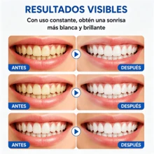 Teeth Kit, Home Use Wireless Teeth Kit with LED Blue Lights Accelerator, Natural Stain Removal Include 1 Teeth Gel Pens Complimentary Color Card - Ver 6