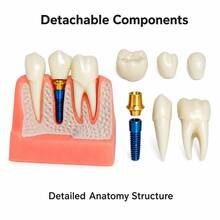 1pc/1 Sets 4X Scale Dental Implant Demonstration Model, Removable Crown Teeth Structure Display Model, Oral Anatomy Display Tool For Study & Presentation - Multicolor - View 3