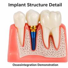 1pc/1 Sets 4X Scale Dental Implant Demonstration Model, Removable Crown Teeth Structure Display Model, Oral Anatomy Display Tool For Study & Presentation - Multicolor - View 4