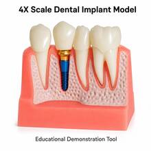 1pc/1 Sets 4X Scale Dental Implant Demonstration Model, Removable Crown Teeth Structure Display Model, Oral Anatomy Display Tool For Study & Presentation - Multicolor - View 2
