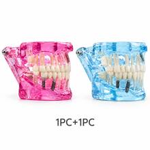 Large Pathology Dental Model, Transparent, Blue, Orange, Pink Optional, Clear Internal Structure, Detachable Oral Model, Large Bridge Explanation Model For Tooth Care, Suitable For Collection, Display Stand Decor, Home Interactive Collection - Multicolor - View 13